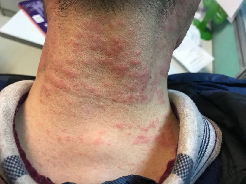 1、膏藥過敏怎么辦？