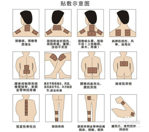 1、肩痛買(mǎi)什么膏藥可以貼？