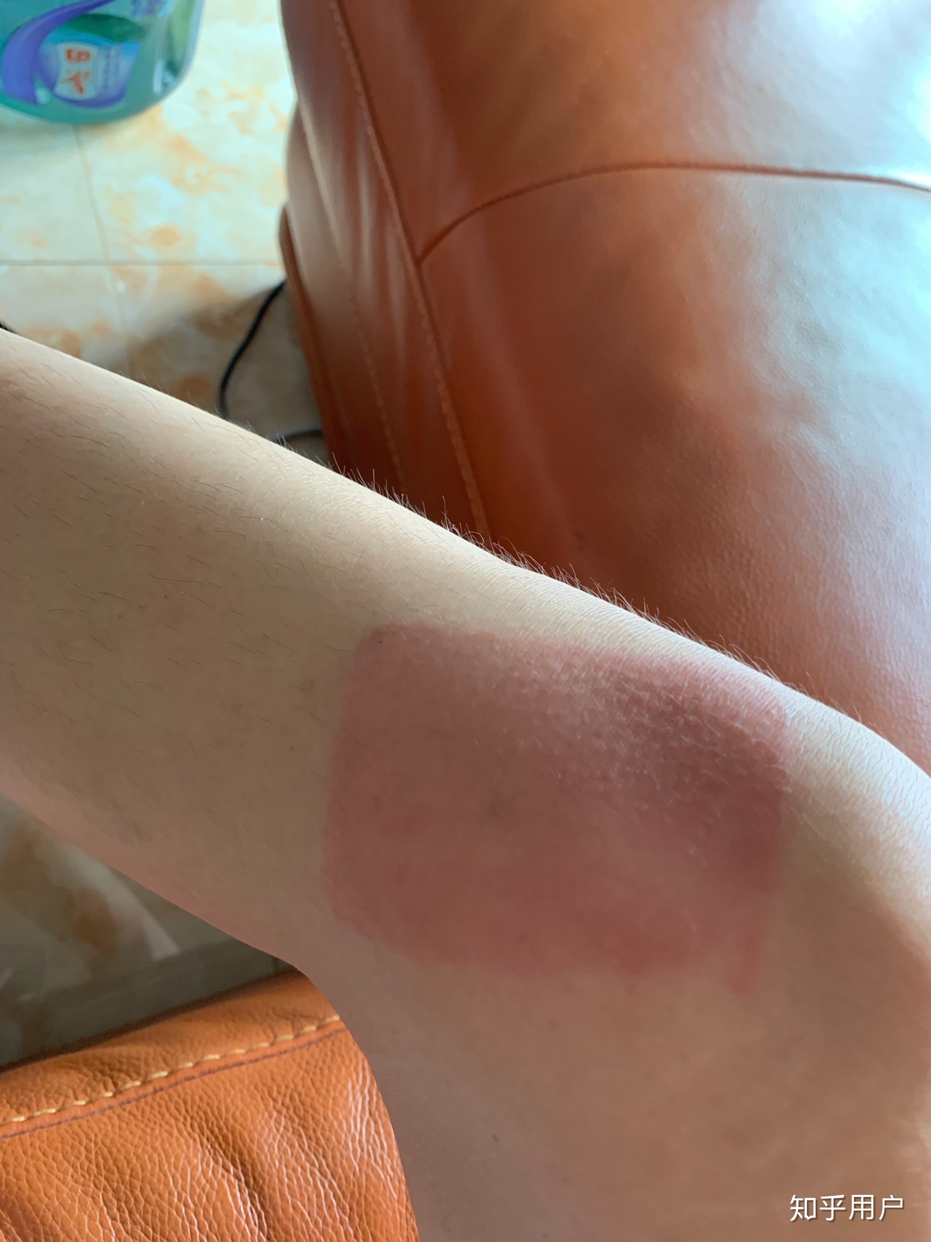 2、貼膏藥的地方有很多紅疙瘩，好不好？